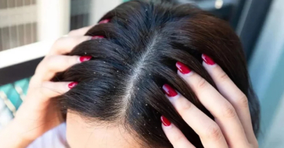 গরমেও মাথা ভর্তি খুশকি? দূর করবেন যেভাবে